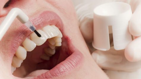 Реминерализация и фторирование зубов