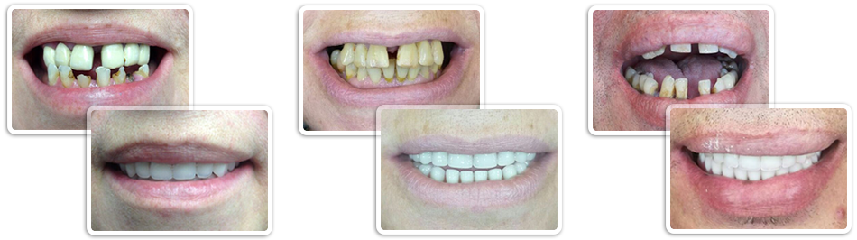 Имплантация зубов До и После фото