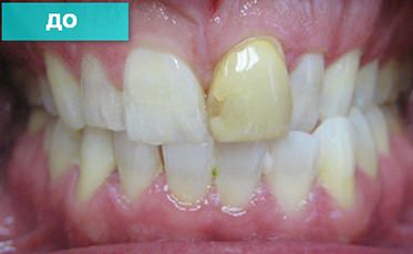 Циркониевые коронки на передние зубы ДО