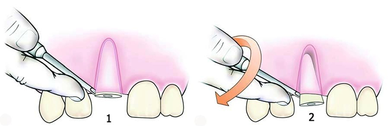 Процедура удаления корней зуба фото