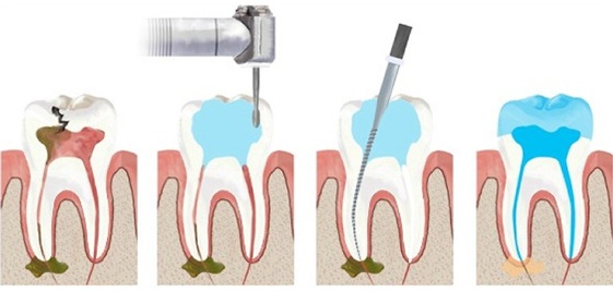 Процедура удаления нерва из зуба фото