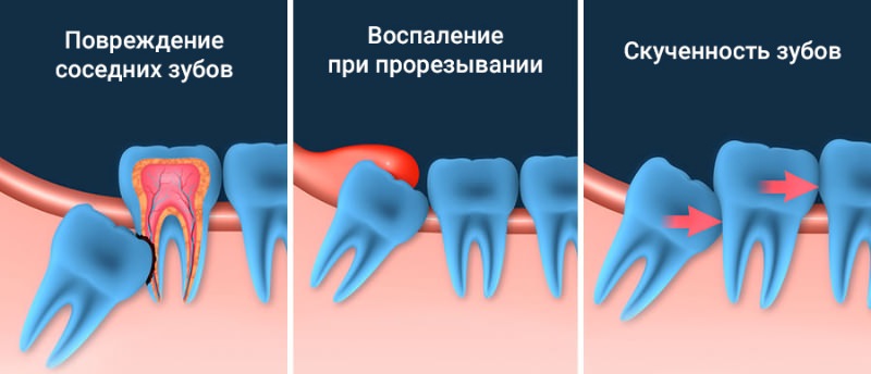 Причины для удаления зубов мудрости