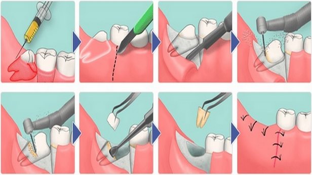 Способ удаления ретинированного зуба мудрости в стоматологии