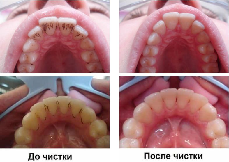 Профессиональная гигиеническая чистка зубов До и После фото