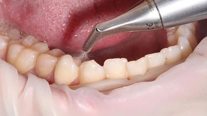 Безопасность гигиенической чистки зубов фото