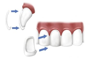Схема установки винира на зуб