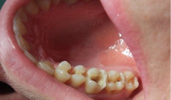Лечение зубов без боли тюмень