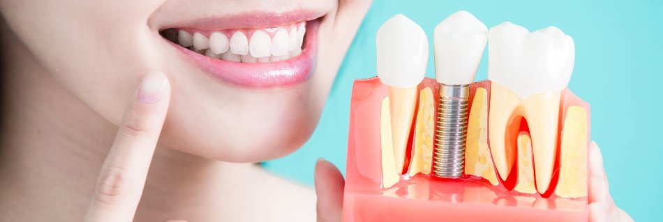 Показания и противопоказания к имплантации зубов