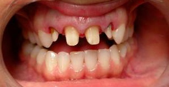Металлокерамические коронки на передние зубы ДО и ПОСЛЕ