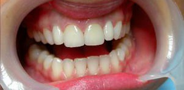 Металлокерамические коронки на передние зубы ДО и ПОСЛЕ