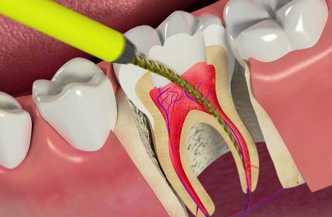 Удаление корня зуба - показания, подготовка к операции, инструменты, этапы удаления, осложнения