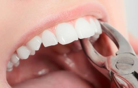 Удаление зубов верхней и нижней челюсти в стоматологии АРТ Дент фото
