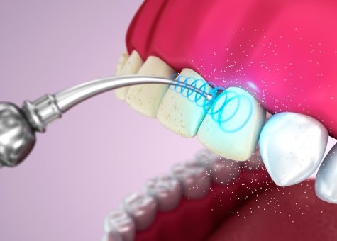 Ультразвуковая чистка зубов в Тюмени фото